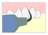 歯石・歯垢の除去